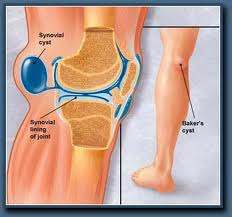 Knee Rplacement Surgery